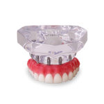 Acrylic Maxilla with 6 Implants and Full-arch Prosthesis