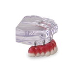 Acrylic Maxilla with 6 Implants and Full-arch Prosthesis