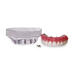 Acrylic Maxilla with 6 Implants and Full-arch Prosthesis