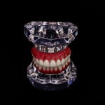 Acrylic Maxilla with 6 Implants and Full-arch Prosthesis