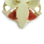 Maxilla with Teeth 11, 12, 14, 18, 24, 26 and 27