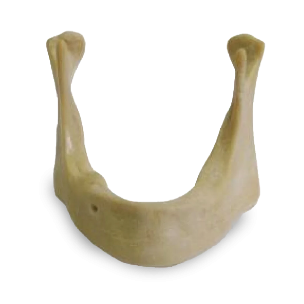 Extra-hard Edentulous Mandible