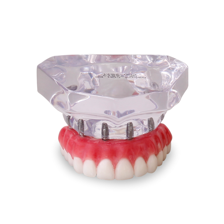 Acrylic Maxilla with 6 Implants and Full-arch Prosthesis