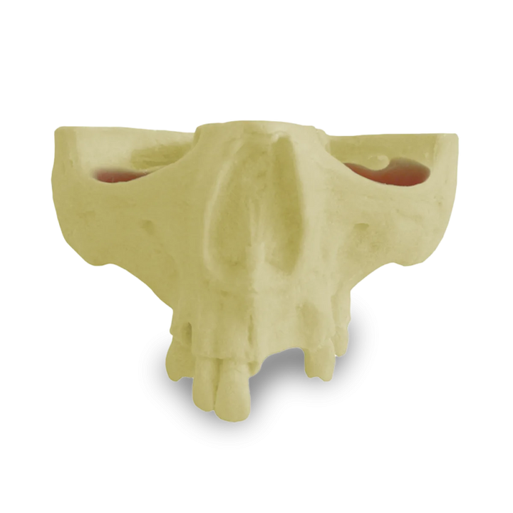 Maxilla with Teeth 11, 12, 14, 18, 24, 26 and 27