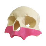 All-on-4® Zygoma Frontal Skull with Gingiva